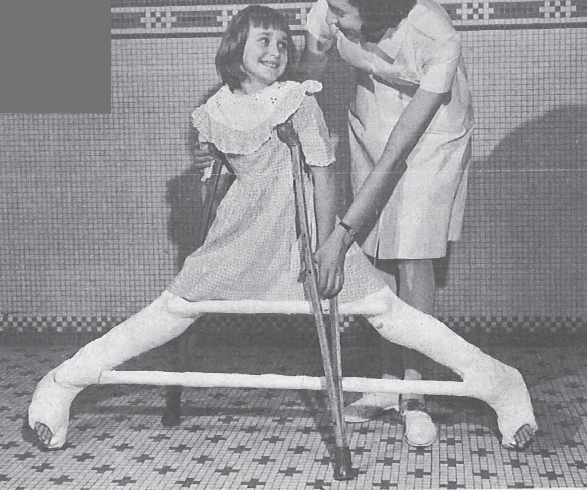 A vintage black-and-white photo of a girl in a Petrie (A-frame) plaster cast that holds both legs wide apart, standing with a crutch beside a smiling nurse